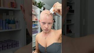 Download lagu I don’t wear wigs for having Alopecia… mp3