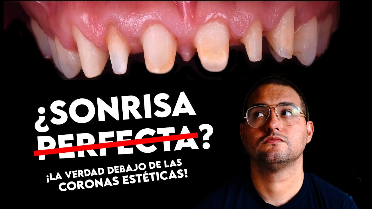 VENDIERON SU ALMA POR UNA SONRISA PERFECTA - De CARILLAS a CORONAS DENTALES por VANIDAD.