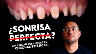 VENDIERON SU ALMA POR UNA SONRISA PERFECTA - De CARILLAS a CORONAS DENTALES por VANIDAD.