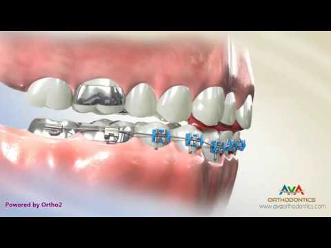 Orthodontic Treatment for Deepbite - Fixed Bite Plate on Front Teeth
