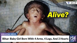Bihar: Baby Girl Born With 4 Arms, 4 Legs, And 2 Hearts