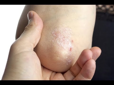 ครีม Diprosalik โรคสะเก็ดเงิน โรคสะเก็ดเงินภายในหู