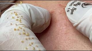 Get ROCK ACNE for women #HoangMySpa200