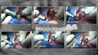 R2Gate Guide Surgery #15, 16, 17