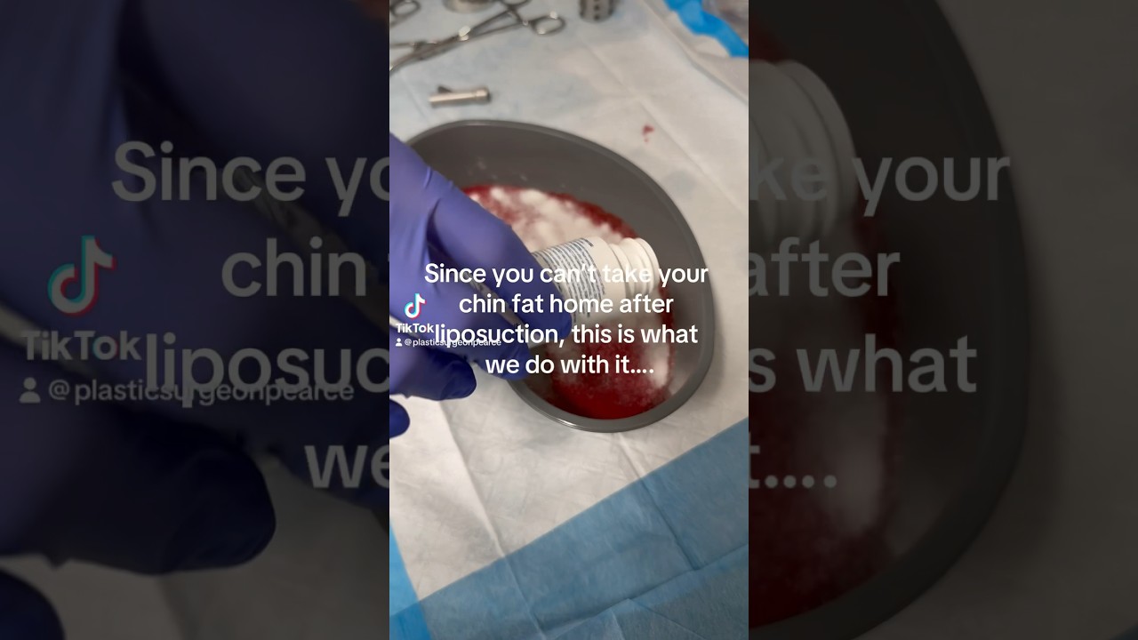 Chin Lipo Fat Disposal || Austin Chin Lipo