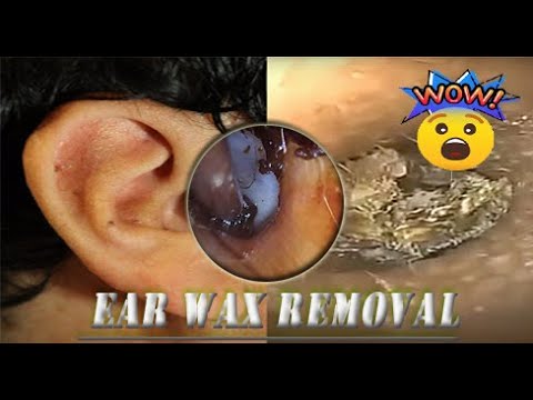 Ear Hook, Jobson Horne & Forceps Ear Wax Removal./Part1