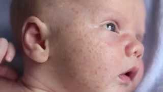 What is Baby Acne? - Boys Town Pediatrics