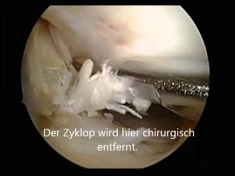 Das Schultergelenk Knochen stieg Avito eine Klammer auf das Kniegelenk kaufen