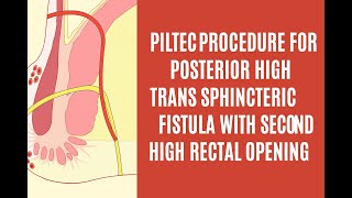 PILTEC procedure  for Posterior High Transsphincteric Fistula with Secondary High Rectal Opening