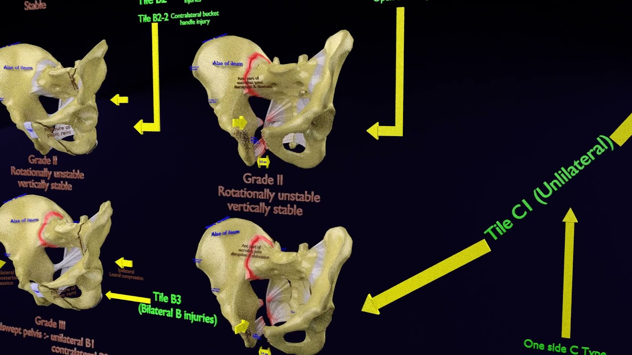 Fraturas da pelve Modelo 3D