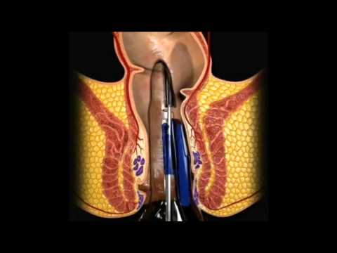 Una diagnosi di prostatite Ghiandola prostatica nei mammiferi