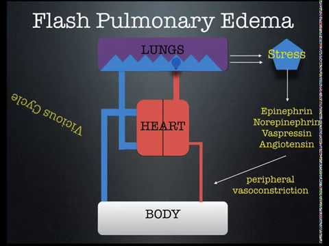Flash Pulmonary Edema lecture by Dr. Zevallos