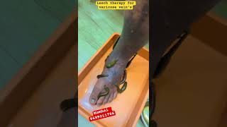 Do leeches help with varicose veins? ( LEECH THERAPY ) #kzhijama#leechtherapy#varicose#shorts#reels