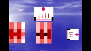 Meningiomas and Radiosurgery