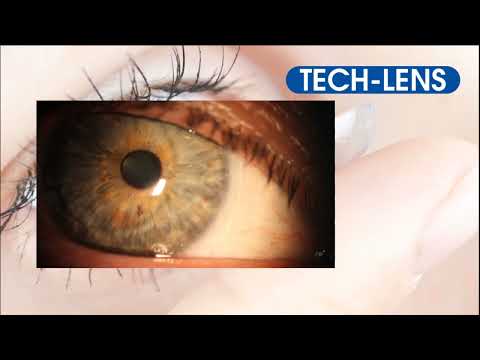 Anpassung torischer Contactlinsen