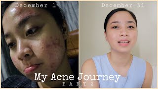 I POPPED MY PIMPLES AND LOOK WHAT HAPPENED. // A must watch video. // HOW TO CURE ACNE PART 2