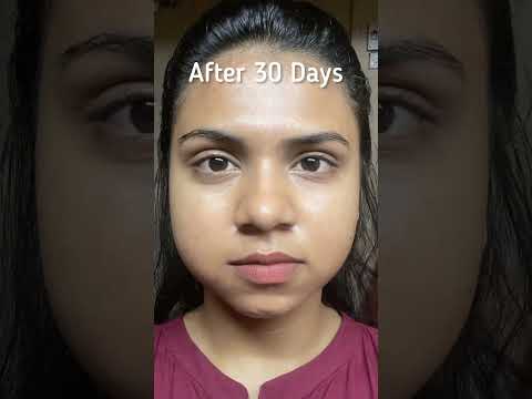 My skincare routine and acne  transformation in just 30 days #skincare #shorts #acnetreatment #acne