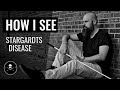 Stargardt Disease / Macular Degeneration - How I See - The Blind Life