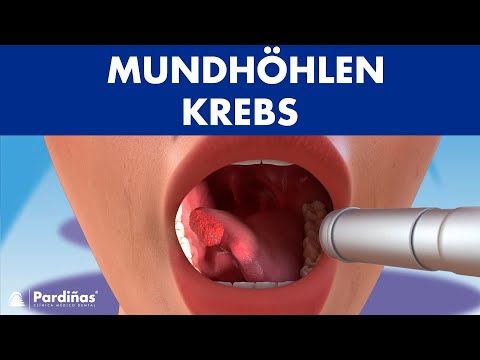 MUNDHÖHLEN KREBS - Symptome, Ursachen und Arten von mundkrebs ©