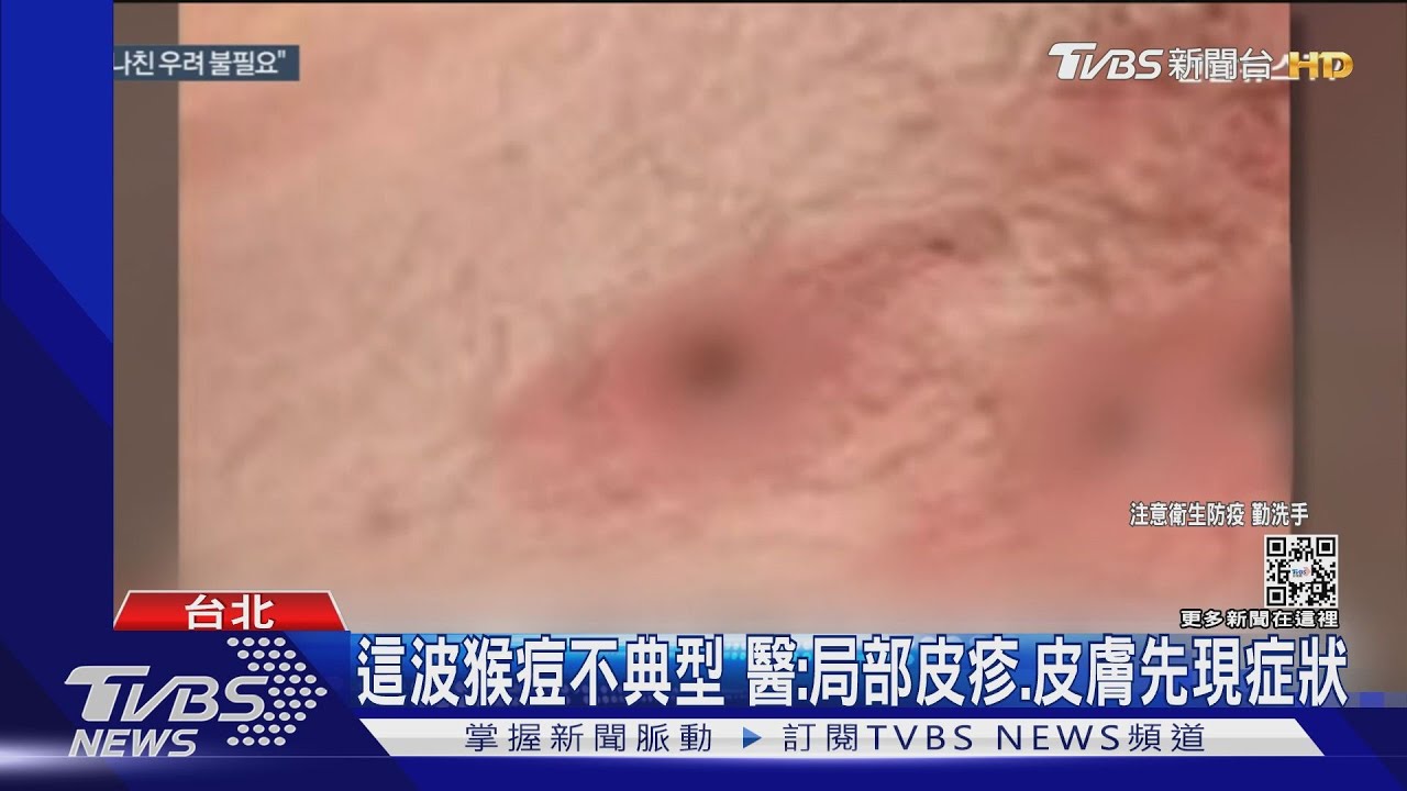 這波猴痘不典型 醫:局部皮疹、皮膚先現症狀