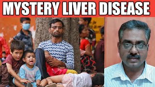 New Mystery Liver Disease in Children Explained | Tamil | Rams Universe