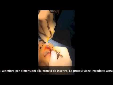 Perché sotto borse di occhi e ombre sotto gli occhi Che esso è possibile rimuovere borse sotto occhi i rimedi più efficaci