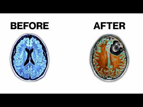 Long Term Effects Of Short Form Content On Your Brain
