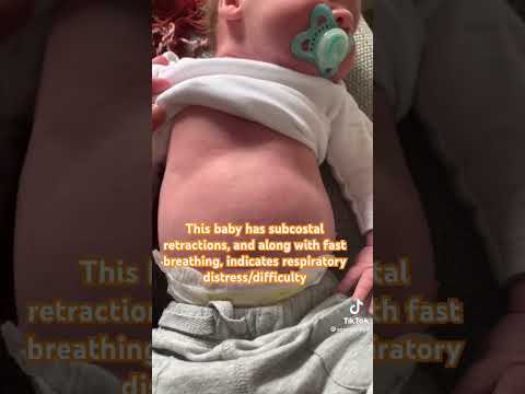Fast breathing in baby | Breathing difficulty | Chest retractions