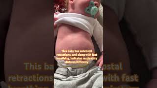 Fast breathing in baby | Breathing difficulty | Chest retractions