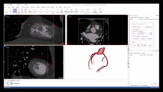 Tutorial: Coronary Vessel Segmentation