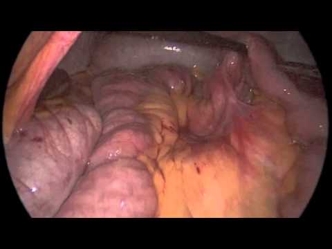 Laparoscopic Internal Hernia Repair and Closure of Peterson's Defect due to Small Bowel Obstruction