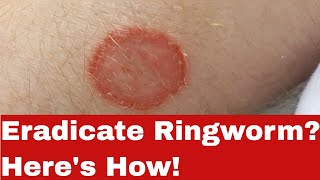 Beat the Itch! How to Get Rid of Ringworm Fast!