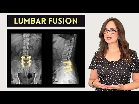 #110 Lumbar Fusion Surgery. Can you exercise?