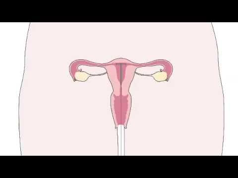 Zakładanie wkładki wewnątrzmacicznej