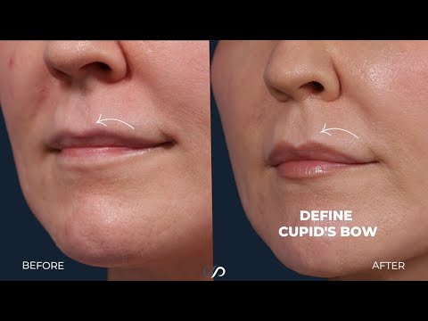 Upper Lip Lift | Before & After | Los Angeles | Dr. David Stoker