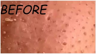 Download Lagu Relax Video ,Satisfying ,nose blackheads, tweezers, acne treatment #50161 Thumbnail