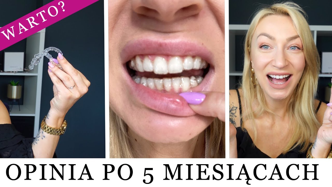 FAKTY I MITY O PROSTOWANIU ZĘBÓW | INVISALIGN VS. APARAT DRUCIANY 🦷