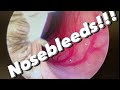 Nosebleeds Epistaxis Causes Prevention Treatments And More