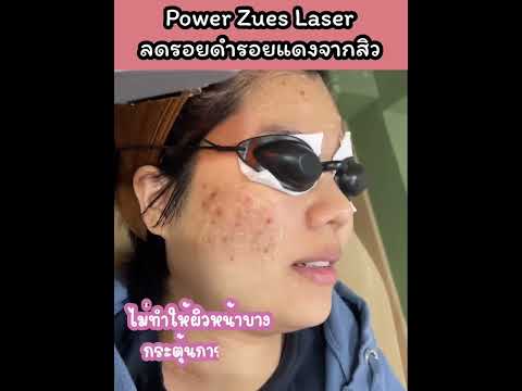 รีวิวโปรแกรม Power Zeus Laser ลดรอยดำ รอยแดง จากสิว