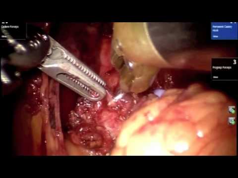 Robotic Repair of Median Arcuate Ligament Syndrome