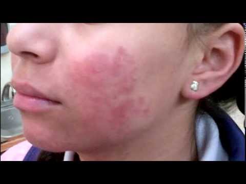 Qué es la urticaria y cómo tratarla de forma natural