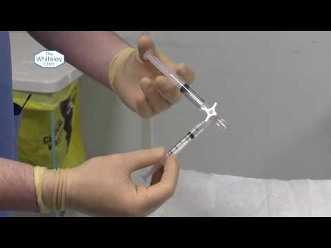 Ultrasound Guided Foam Sclerotherapy by Mark Whiteley of The Whiteley Clinic