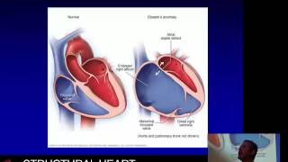 Ebstein’s anomaly of the tricuspid valve – Prof David Celemajer