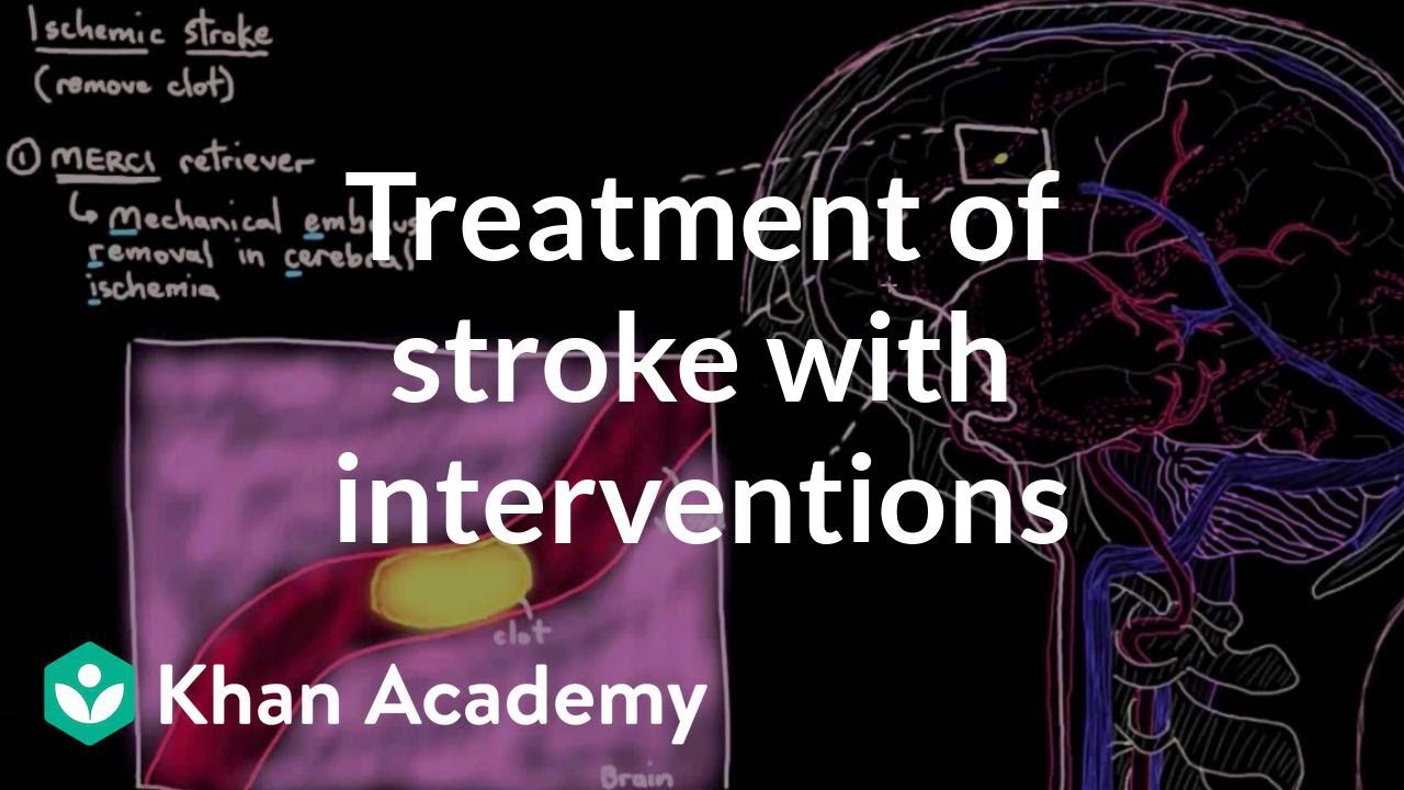 Treatment of stroke with interventions | Circulatory System and Disease | NCLEX-RN | Khan Academy