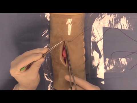 Simple Interrupted Suture Pattern