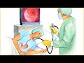 Endoscopic Procedure - Indications, Types, How It Is Done, Risks, And Complications