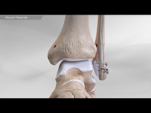 FibuLock® Fibular Nail