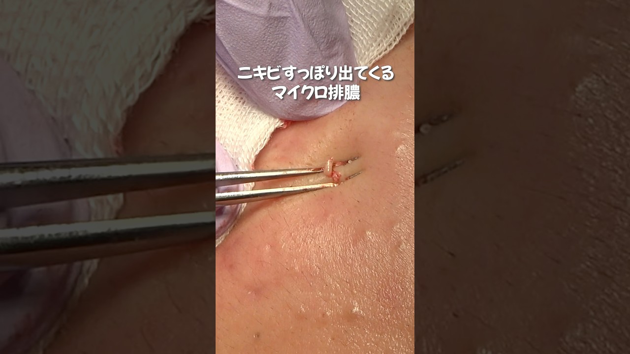 コメド圧出・角栓除去〜マイクロ排膿でニキビ治療 【神戸山手クリニック】 #角栓除去 #ニキビ圧出 #ニキビ芯出し #毛穴 #角栓 #粉瘤 #blackheads #pimplepopping