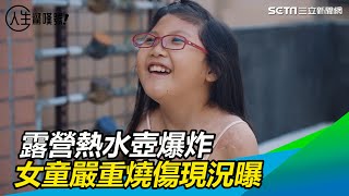 熱水壺爆炸！女童嚴重燒傷　疤痕緊纏上半身