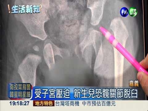 新生兒髖關節脫臼 容易長短腳